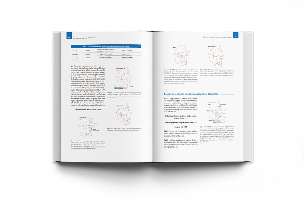 Arte y Ciencia de la Genioplastia Deslizante