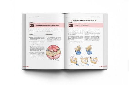 Cirugía Ortognática - Técnicas, Consejos y Complicaciones