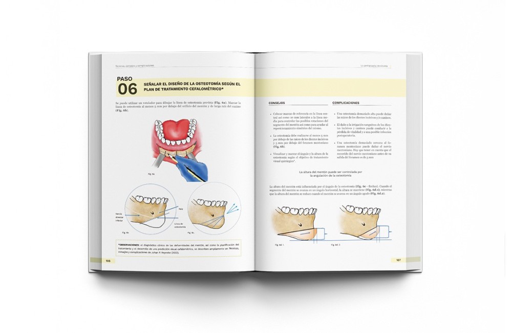 Cirugía Ortognática - Técnicas, Consejos y...