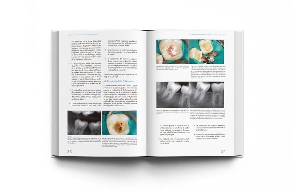 Materiales Biocerámicos en Endodoncia Clínica