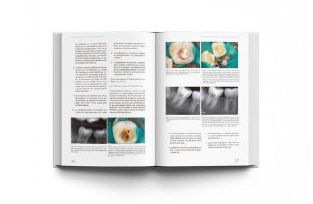 Materiales Biocerámicos en Endodoncia Clínica