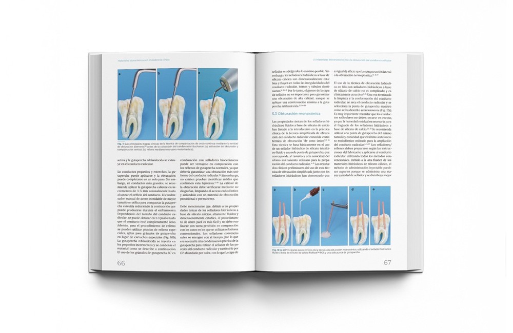 Materiales Biocerámicos en Endodoncia Clínica