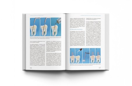 Materiales Biocerámicos en Endodoncia Clínica