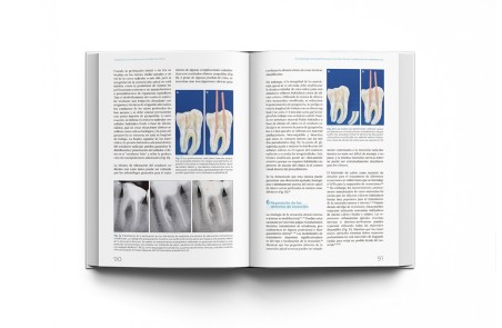 Materiales Biocerámicos en Endodoncia Clínica