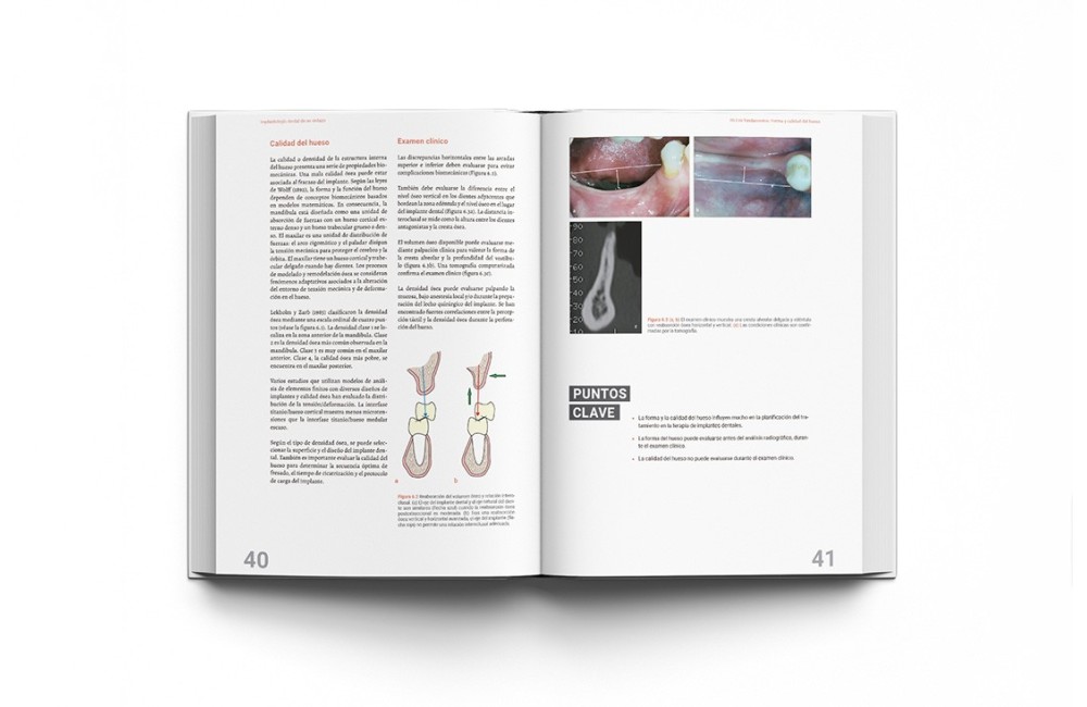 Implantología Dental de un Vistazo
