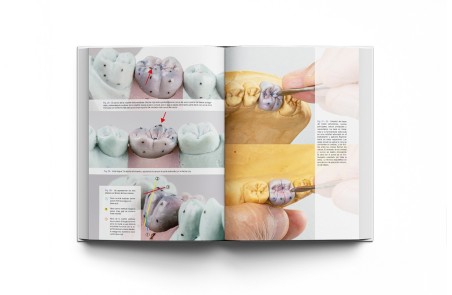 Implantología Dental de un Vistazo