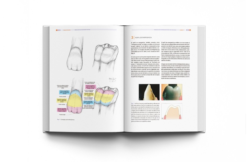 Implantología Dental de un Vistazo