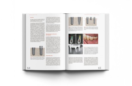 Implantología Dental de un Vistazo