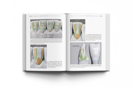 Implantología Dental de un Vistazo