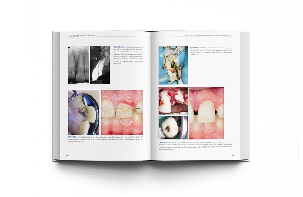 Traumatología Dental de un Vistazo
