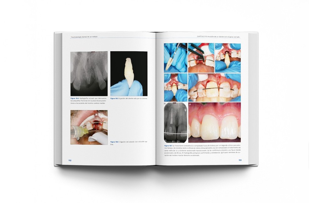 Traumatología Dental de un Vistazo