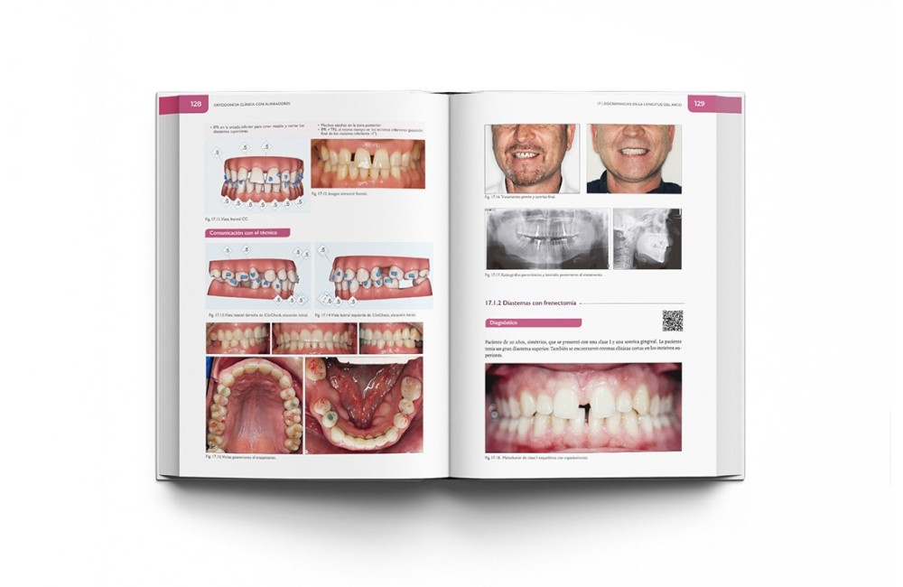 Ortodoncia Clínica con Alineadores