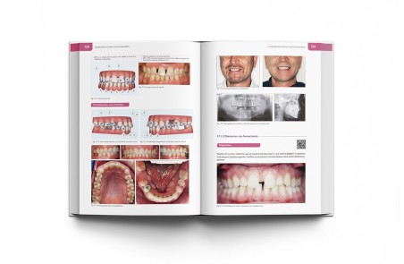 Ortodoncia Clínica con Alineadores
