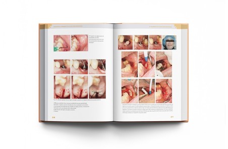 Diagnóstico y Tratamiento de la Infección Odontógena