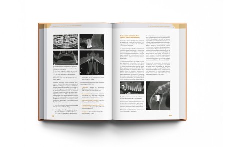 Diagnóstico y Tratamiento de la Infección Odontógena