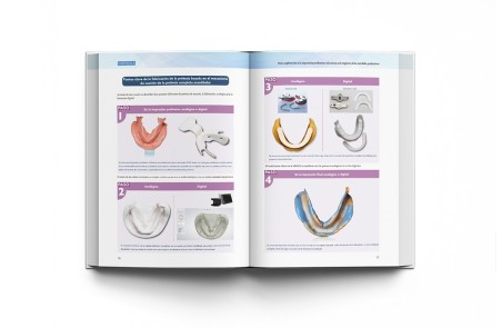 Prótesis Completa Mandibular con Técnica de Succión Efectiva