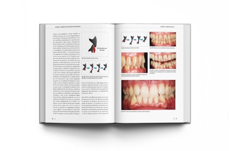 Oclusión y Tratamiento de los Pacientes con Desgastes 2 Volúmenes