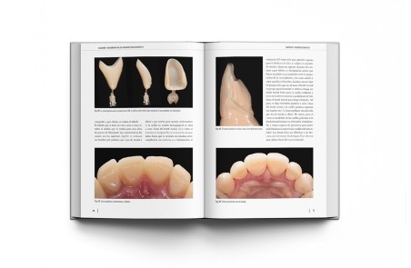 Oclusión y Tratamiento de los Pacientes con Desgastes 2 Volúmenes