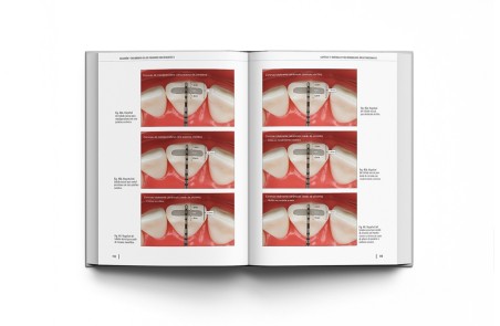 Oclusión y Tratamiento de los Pacientes con Desgastes 2 Volúmenes