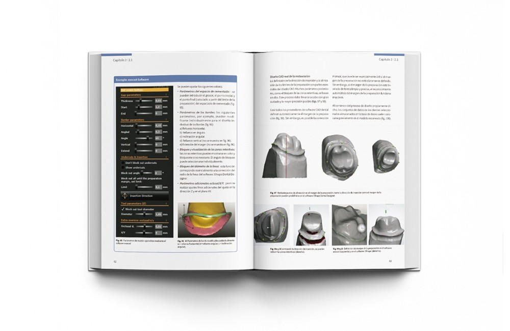 CAD-CAM en Odontología Digital