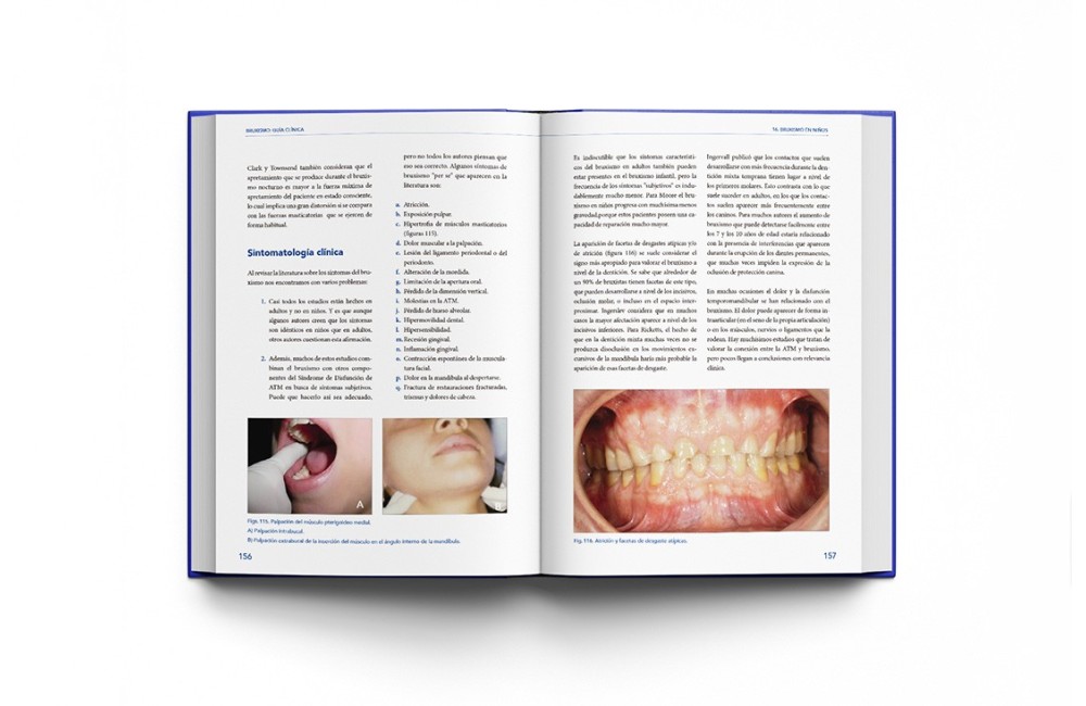 Bruxismo: Guía Clínica
