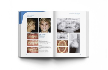 Sistema Damon 4 Kids. Tratamiento Ortodóntico Fijo en la Dentición Mixta