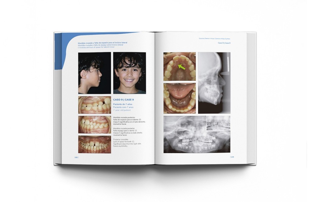 Sistema Damon 4 Kids. Tratamiento Ortodóntico...