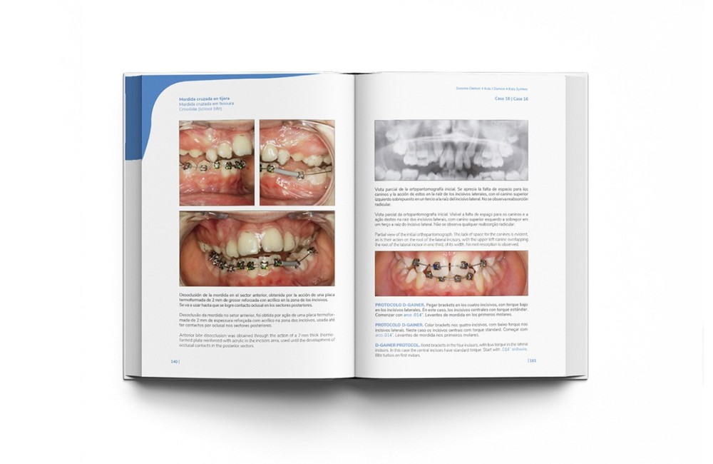 Sistema Damon 4 Kids. Tratamiento Ortodóntico...