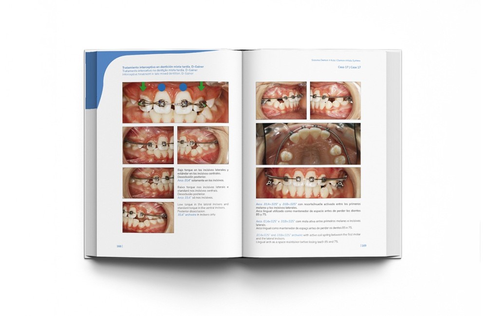 Sistema Damon 4 Kids. Tratamiento Ortodóntico...