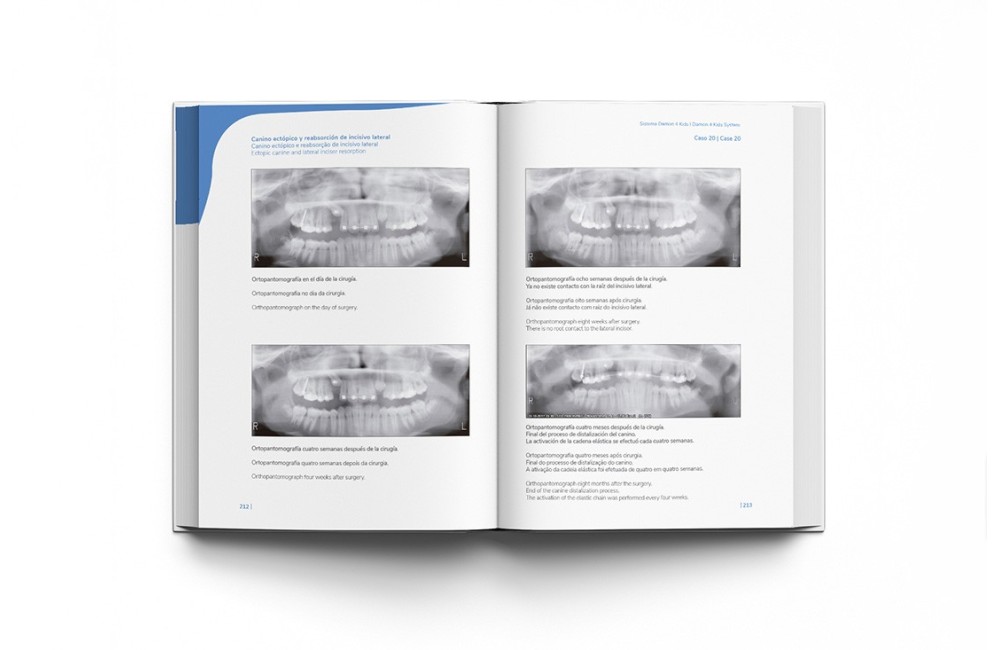 Sistema Damon 4 Kids. Tratamiento Ortodóntico...