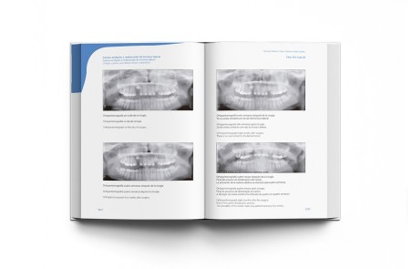 Sistema Damon 4 Kids. Tratamiento Ortodóntico Fijo en la Dentición Mixta