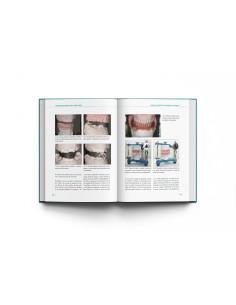 Sobredentaduras Sobre Implantes: Manual Clínico 2