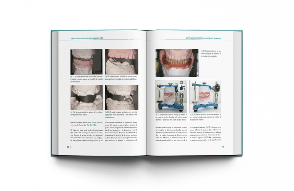 Sobredentaduras Sobre Implantes: Manual Clínico