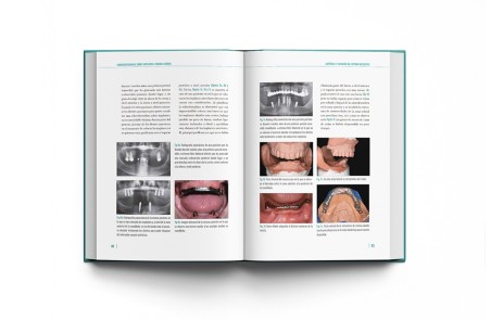 Sobredentaduras Sobre Implantes: Manual Clínico