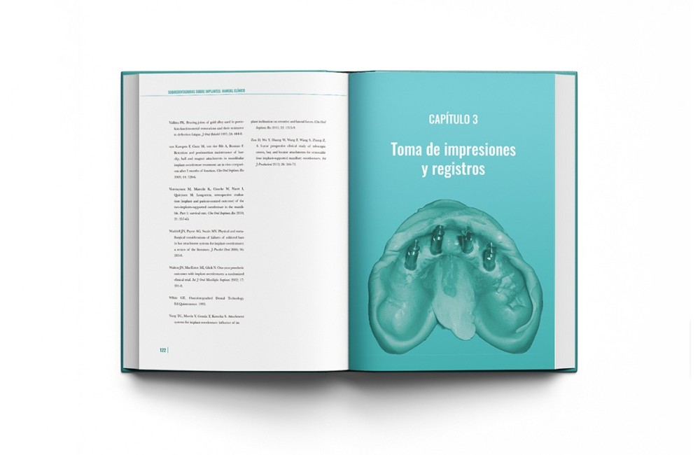 Sobredentaduras Sobre Implantes: Manual Clínico