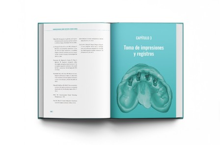 Sobredentaduras Sobre Implantes: Manual Clínico