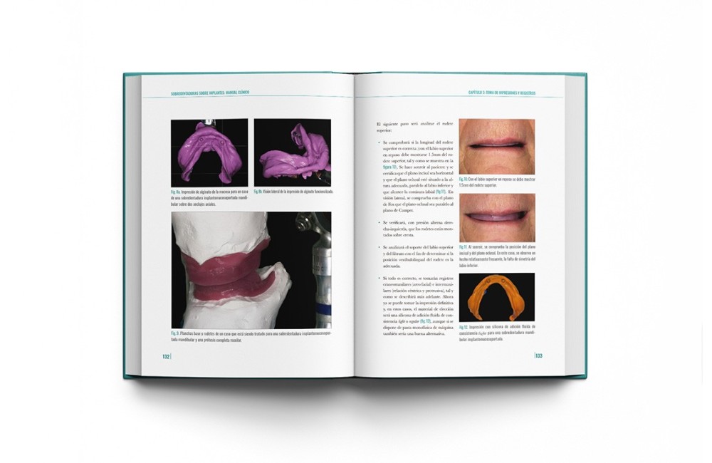 Sobredentaduras Sobre Implantes: Manual Clínico