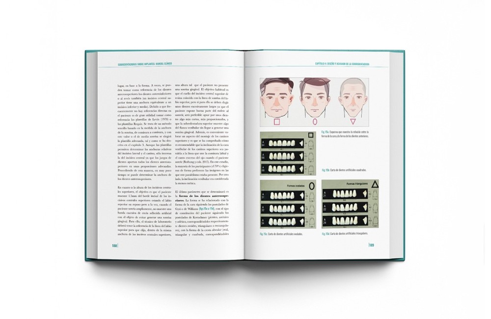Sobredentaduras Sobre Implantes: Manual Clínico