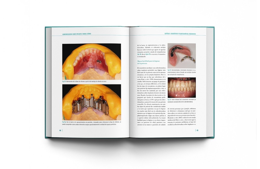 Sobredentaduras Sobre Implantes: Manual Clínico