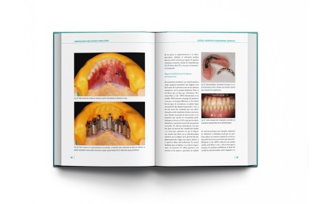 Sobredentaduras Sobre Implantes: Manual Clínico