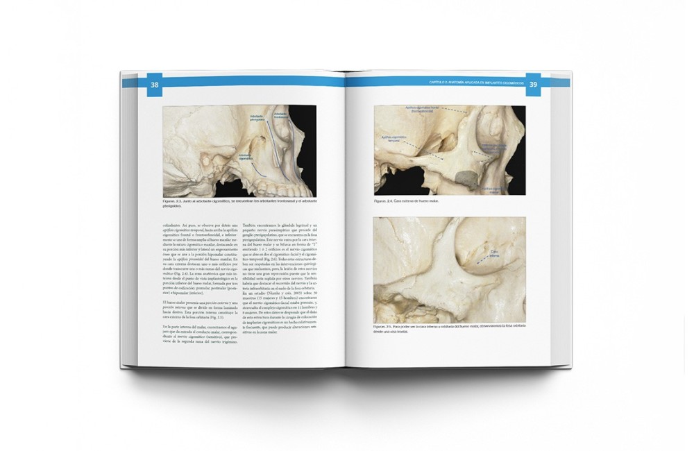 Atlas de Implantes Cigomáticos