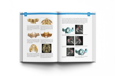 Atlas de Implantes Cigomáticos