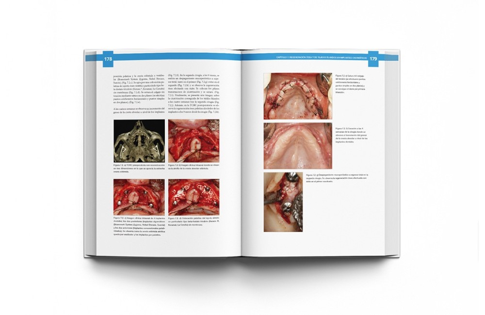 Atlas de Implantes Cigomáticos