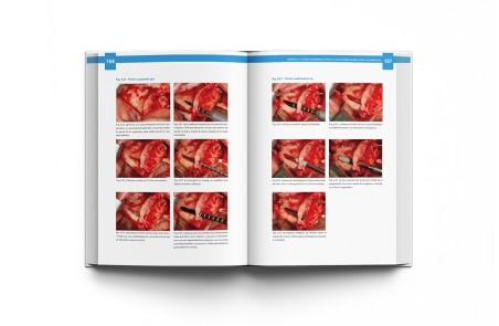 Atlas de Implantes Cigomáticos