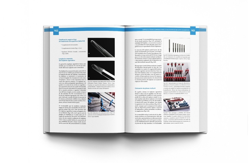 Atlas de Implantes Cigomáticos