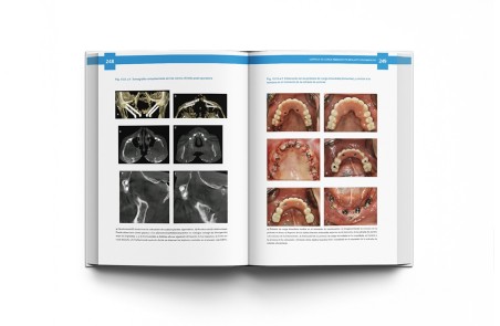 Atlas de Implantes Cigomáticos