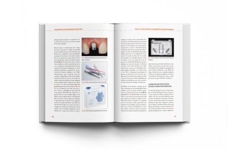 Restauración del Diente Endodonciado Manual Clínico