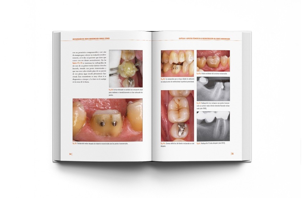 Restauración del Diente Endodonciado Manual...