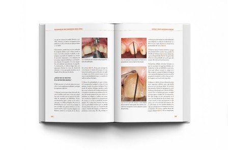 Restauración del Diente Endodonciado Manual Clínico