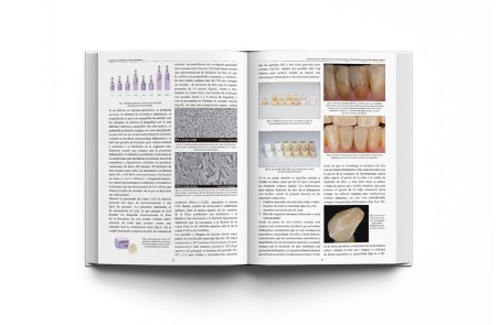 Las Claves de la Prótesis Fija en Cerámica